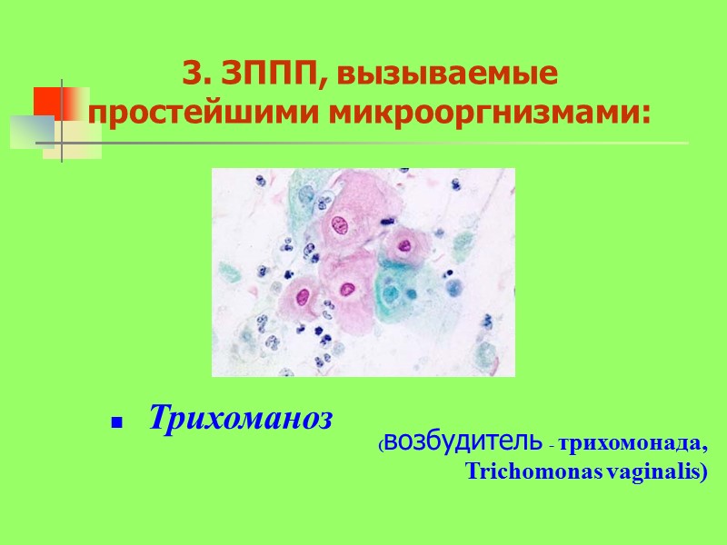 3. ЗППП, вызываемые простейшими микрооргнизмами:      Трихоманоз   